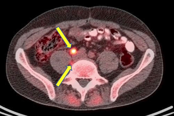 prostate imaging scan showing "hot spots"