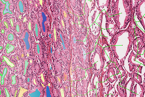 Photo of AI tools aim to identify which prostate cancer patients may require adjuvant therapy