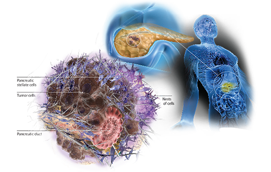 pancreatic cancer illustration