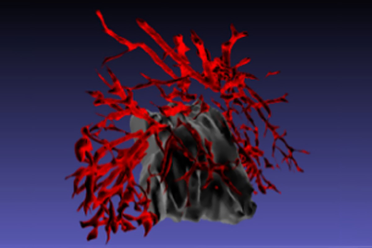 3D rendering of lung tumor