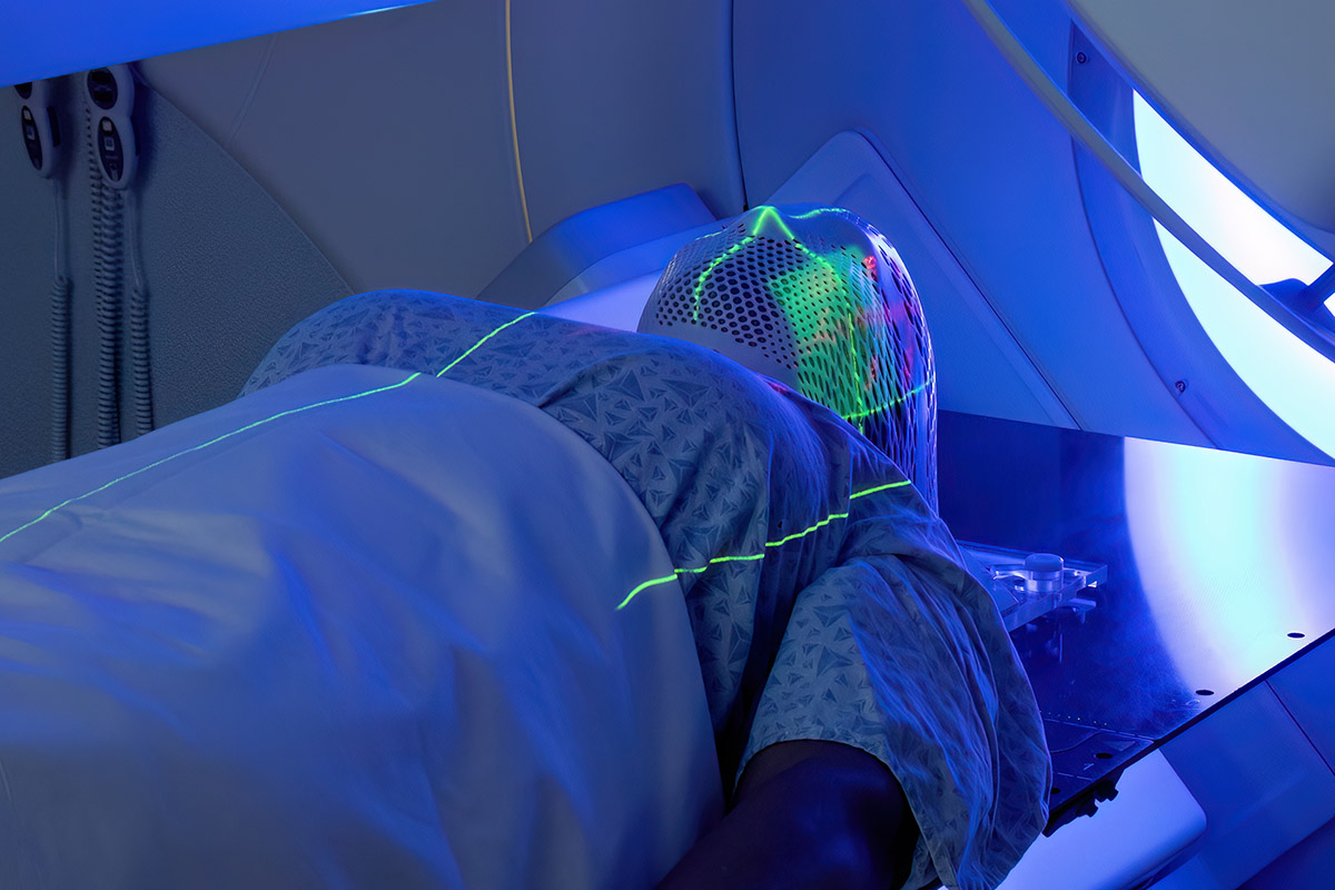 Patient receiving radiotherapy for a head and neck tumor (stock image)