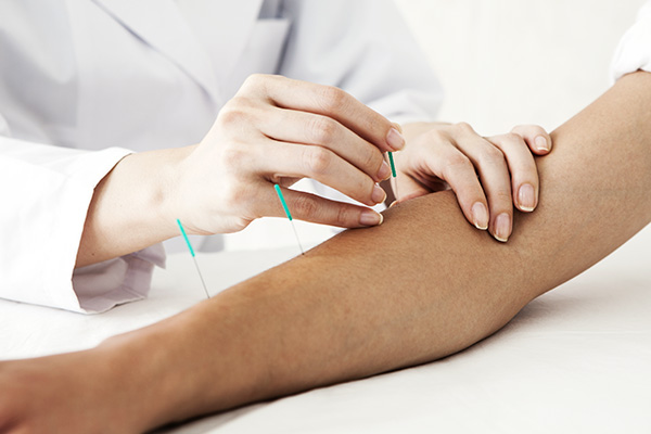 Acupuncturist placing needles on an arm (stock image)